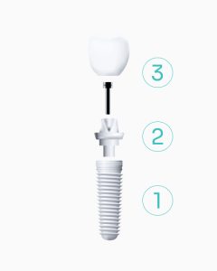 parts of a dental implant