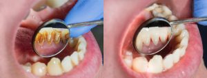 close up shot of before and after teeth tartar removal