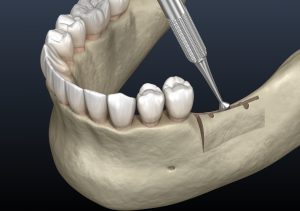 3d model of ridge augmentation surgery