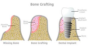 bone graft for dental implant