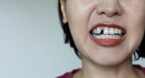 woman with missing tooth (flipped)