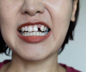 woman with missing tooth (featured)