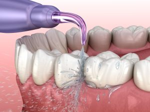 waterpik cleaning teeth