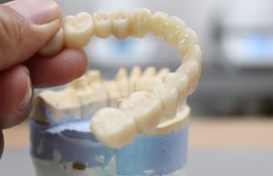 fixed zirconia bridge