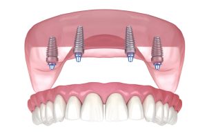 all on four dental implant for upper teeth