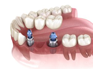 implant-supported dental bridge