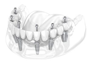 all on 6 dental implants in jaw