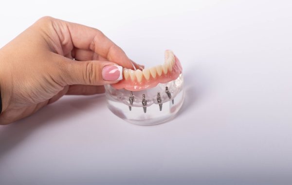 implant-supported denture