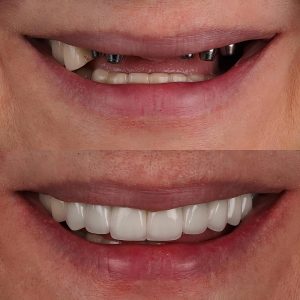 before and after showing dental implants in the upper jaw, with and without the prosthetic bridge