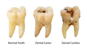 diagram comparing normal tooth to teeth with dental caries and dental cavities