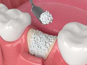 dental bone grafting