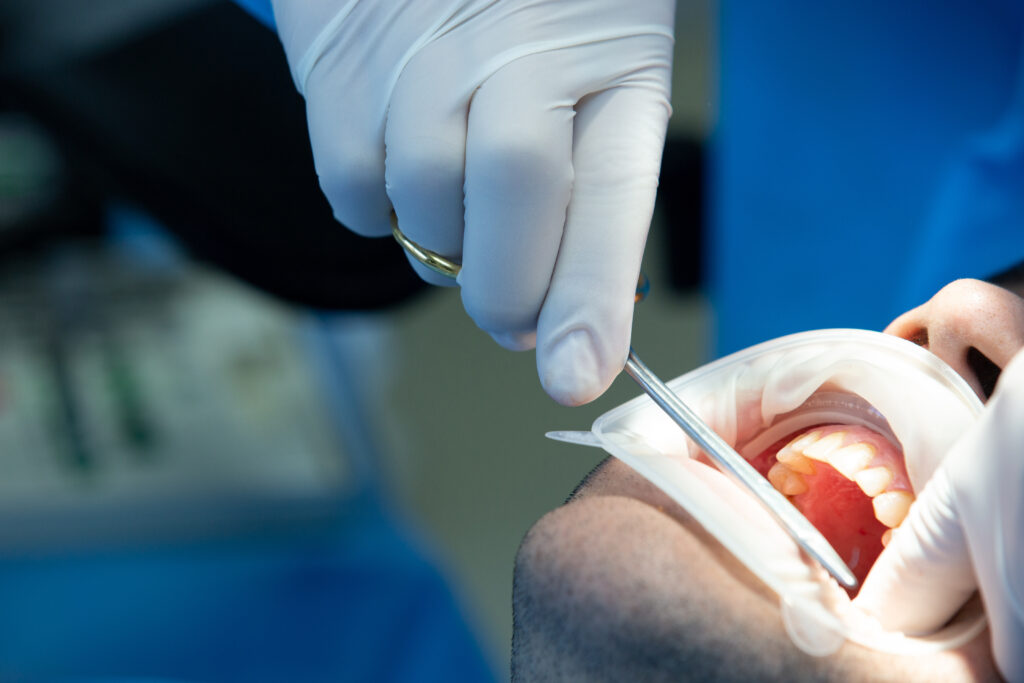 What Should a Tooth Extraction Look Like When Healing - Spectrum Dental