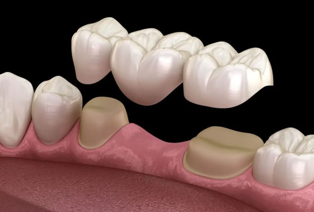 3D illustration of a dental bridge being placed over prepared teeth to replace a missing tooth