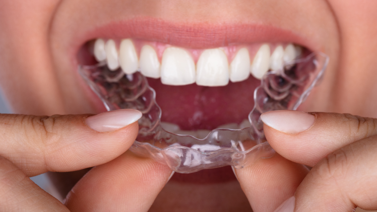 A close up of a female placing a clear aligner tyray into her mouth.